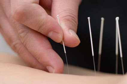An Acupuncture Treatment