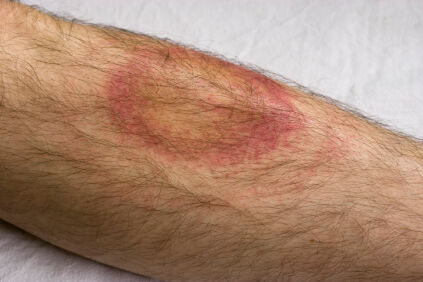 Lyme Rash