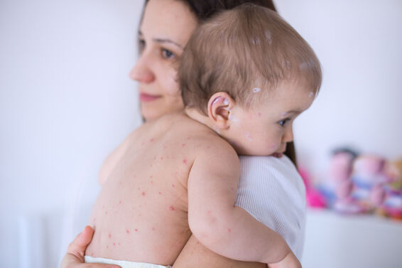 baby with chicken pox