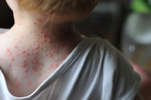 boy with chicken pox