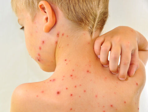 boy scratching chickenpox