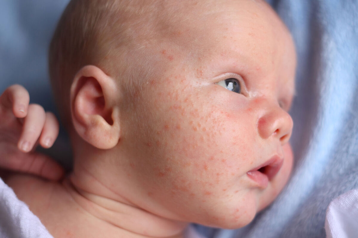 baby acne on newborn cheeks