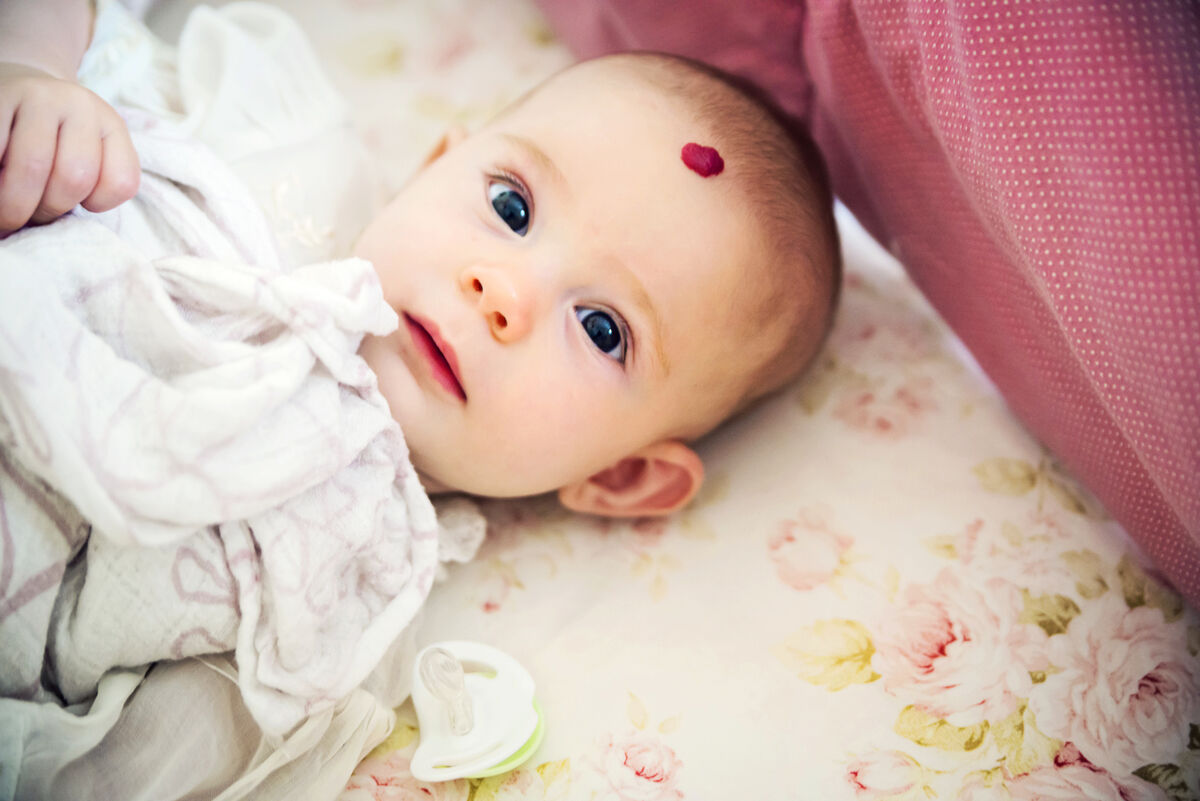 Baby girl with a strawberry mark out hemangiona with a heart shape on forehead