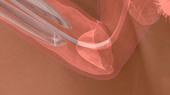 Embryo transfer close up