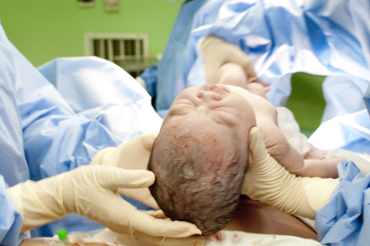 Episiotomy