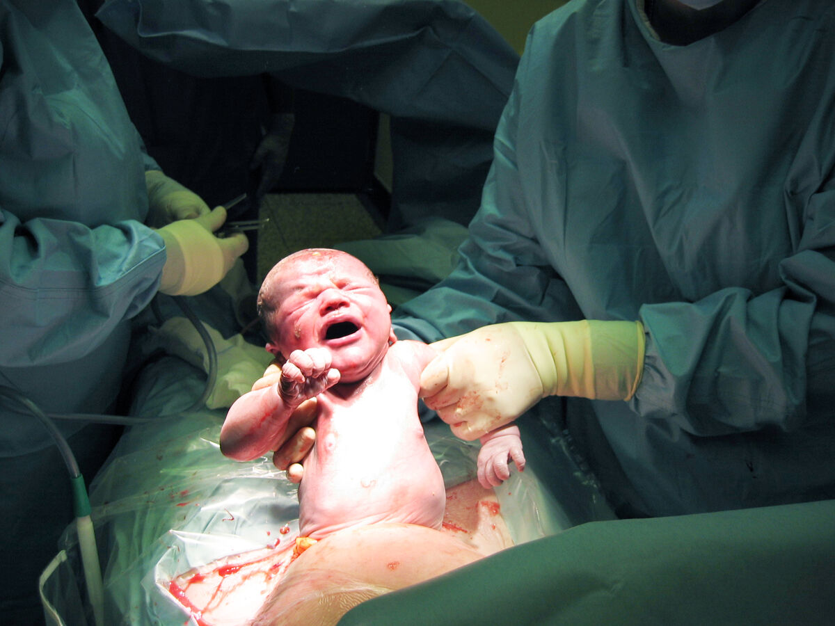 Baby being born via Caesarean Section