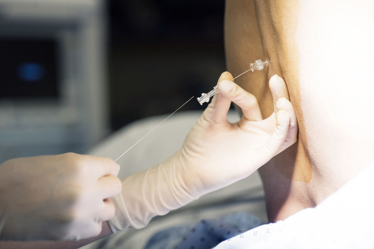 Epidural anesthesia