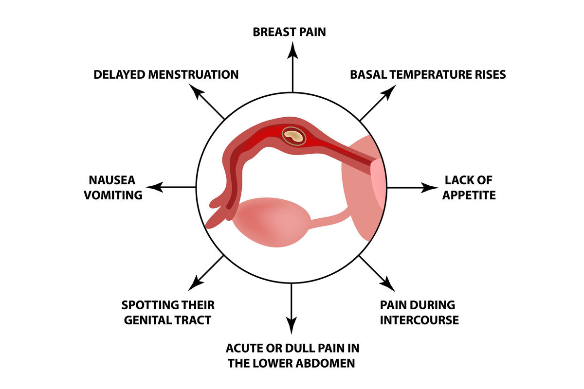 Symptoms of ectopic pregnancy