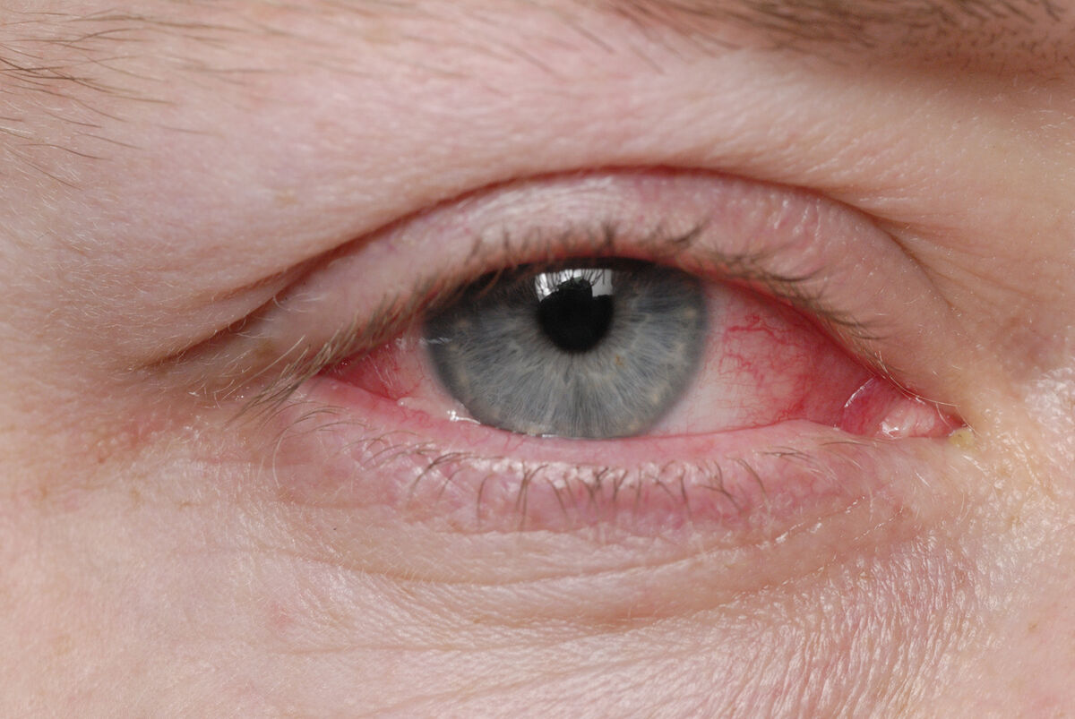 Antibiotic eye drops for pink eye