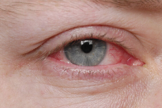 Antibiotic eye drops for pink eye