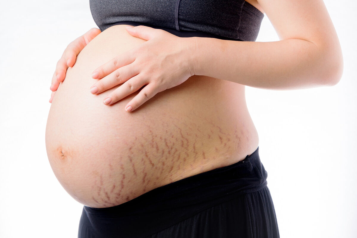 Red pregnancy stretch marks on belly