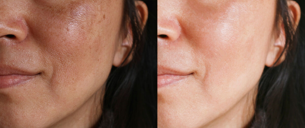 melasma on woman's face