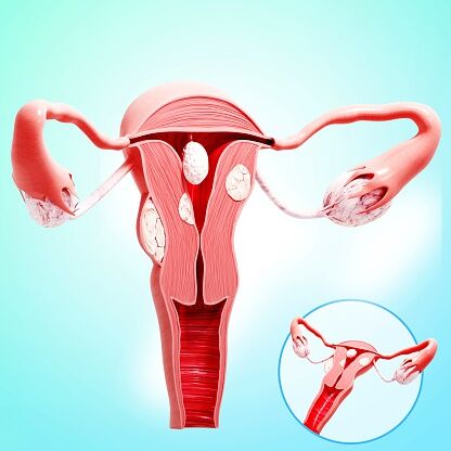 Uterine cancer