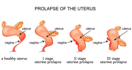 Prolapse of the uterus