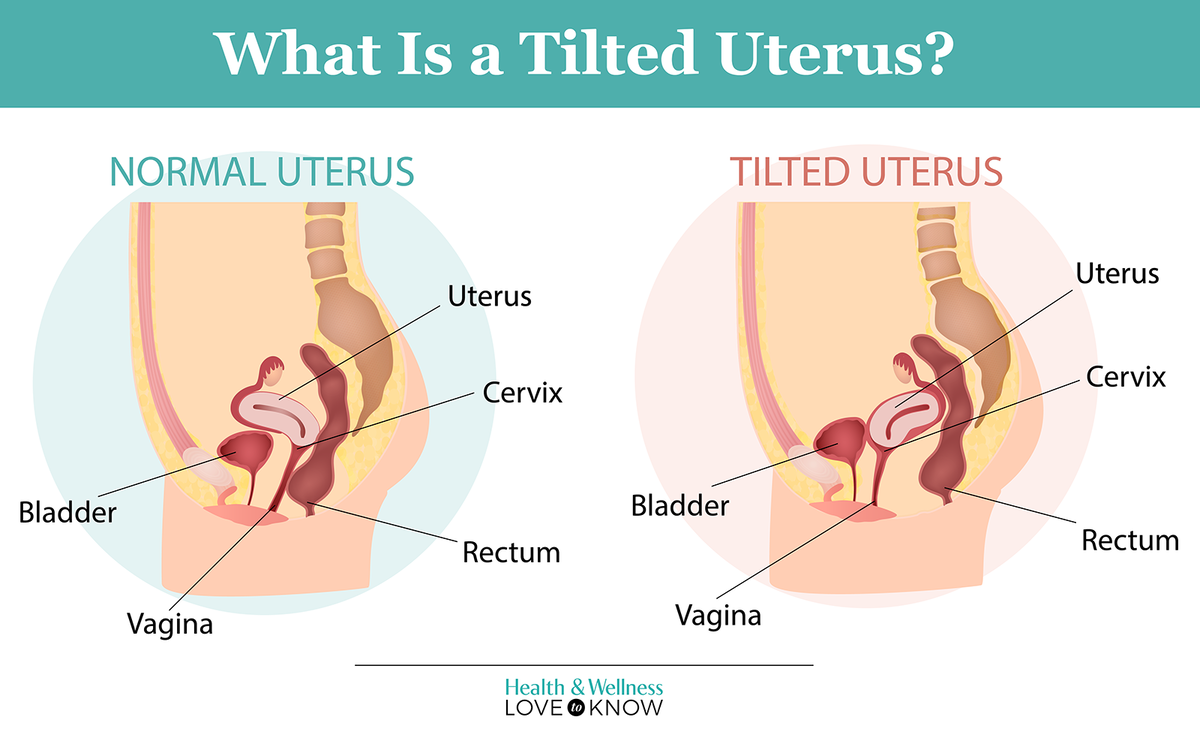 Tilted uterus infographic