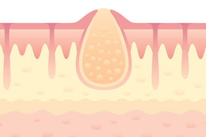 Skin Abscess