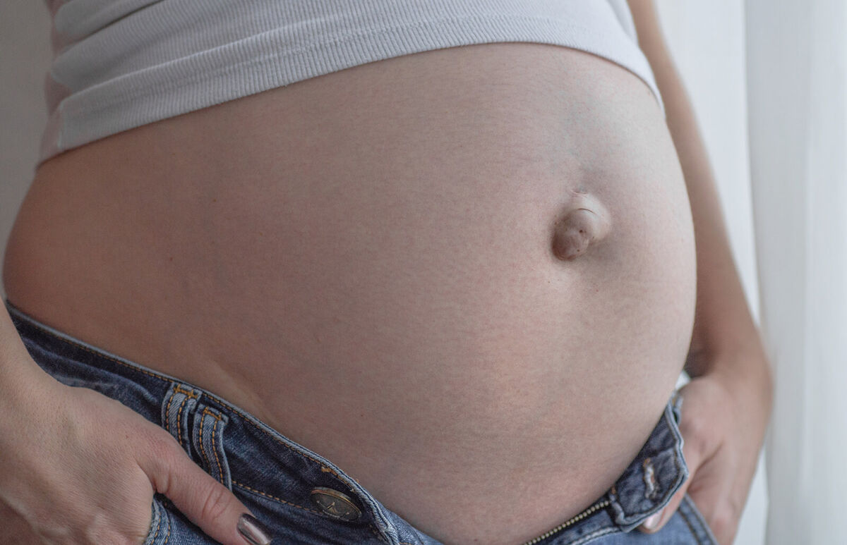 Umbilical hernia in a pregnant woman