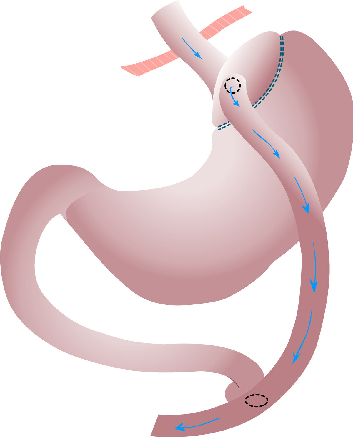 Gastric bypass diagram