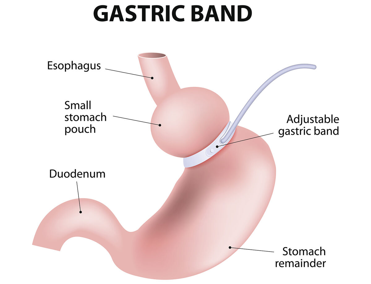 Adjustable gastric band