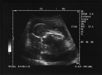 Sonogram of 6-week-old embryo