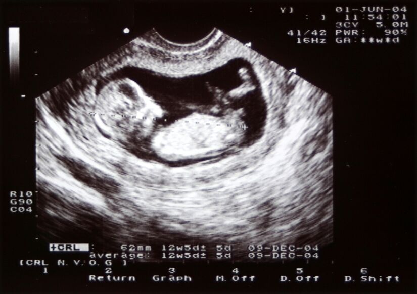 ultrasound of 12 week baby