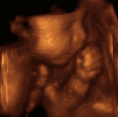 3D ultrasound pregnancy