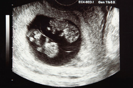 ultrasound of twins