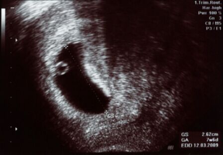 Ultrasound of embryo implanted in the uterus