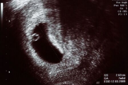 Ultrasound of embryo implanted in the uterus