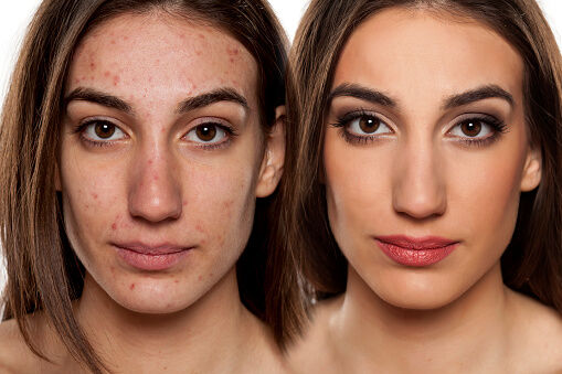 Before and after acne