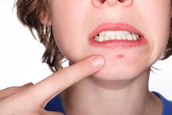 benzolyl peroxide fights acne