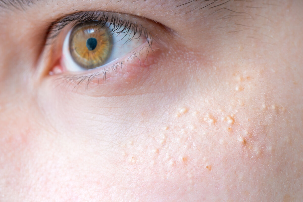 milia pimples