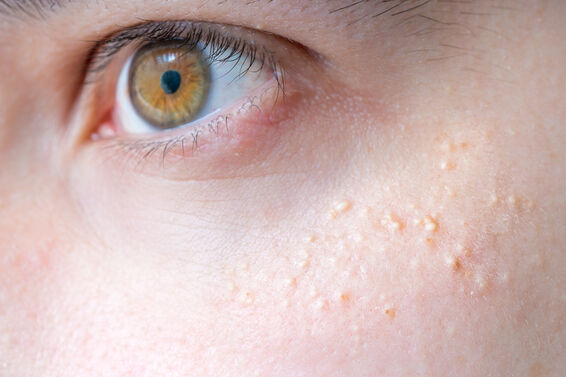 milia pimples