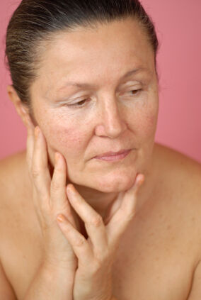 Aging skin with acne