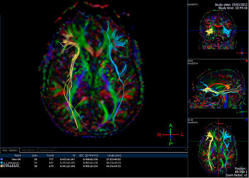 Tractography image of the brain