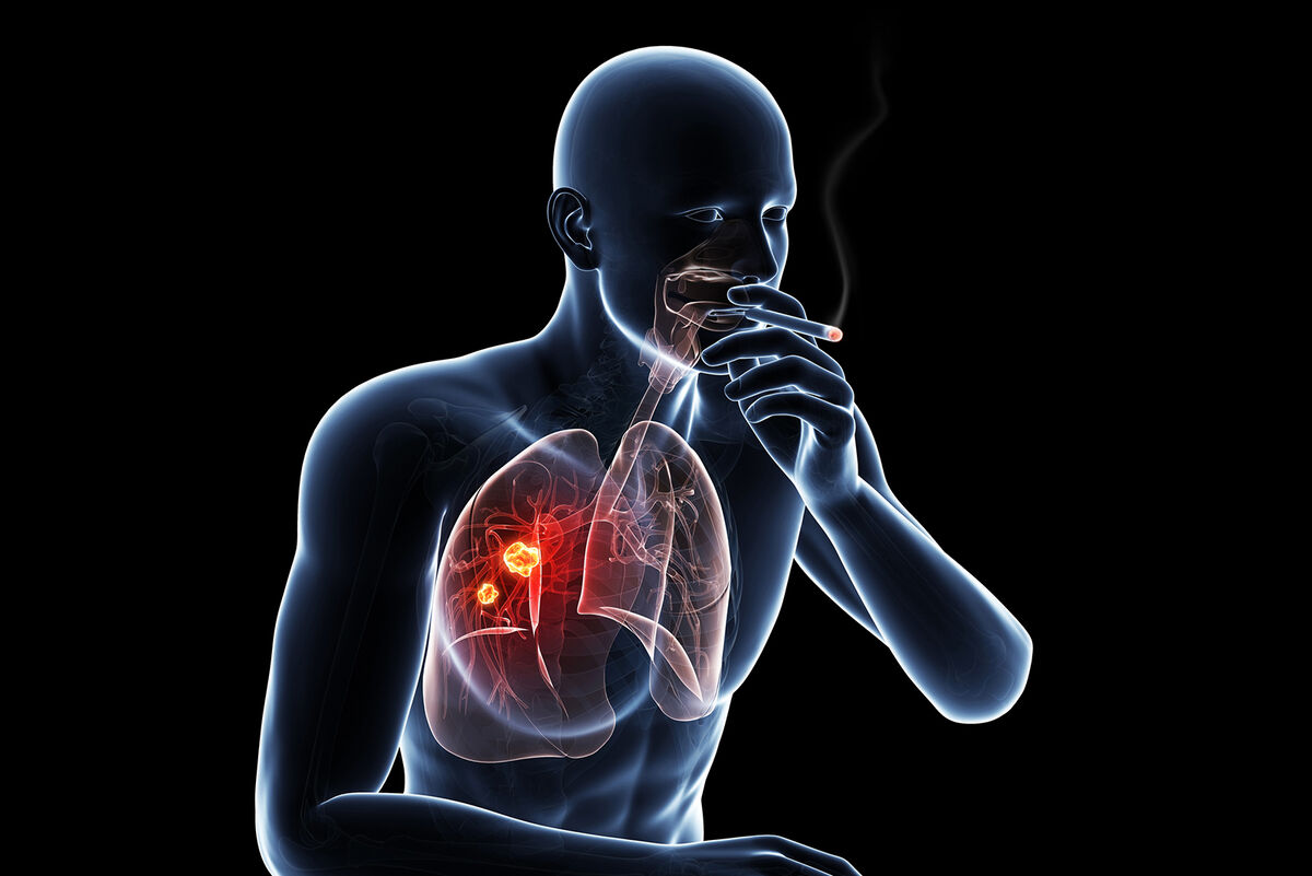 Lung cancer due to smoking
