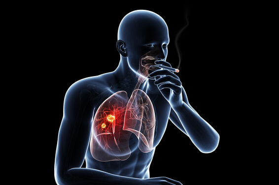 Lung cancer due to smoking