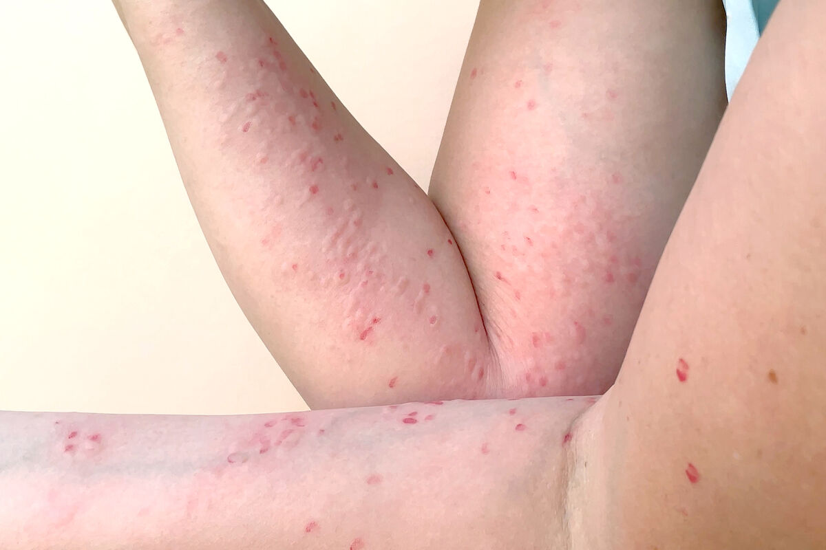Monkey pox virus rash